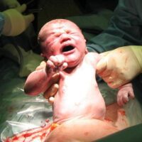 Doral Birth Injury Attorney