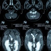Miami Failure to Diagnose Hydrocephalus Attorney
