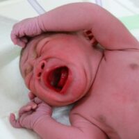 Miami Birth Asphyxia Attorney