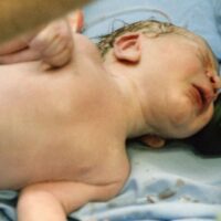 Fort Myers Erb's Palsy Attorney